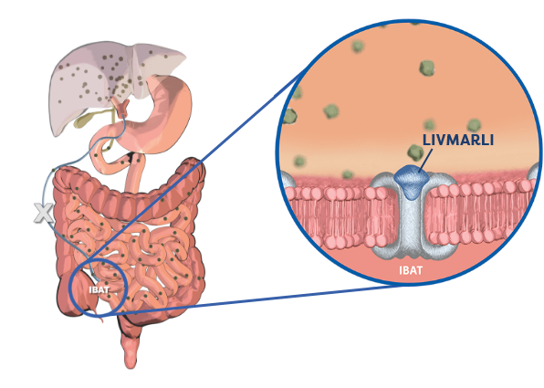 Ileal bile acid transporter (IBAT) inhibitor